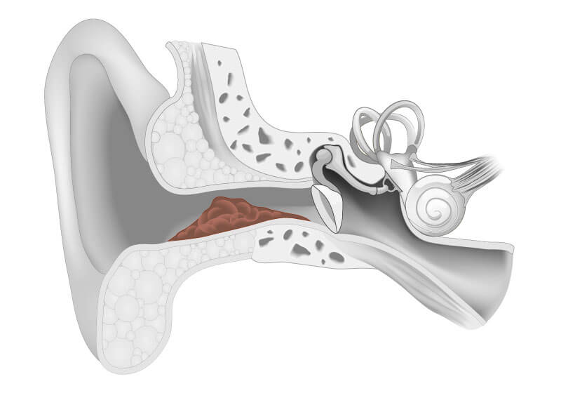 Ear cleaning (ear toilet)